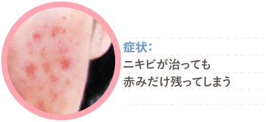 番号 敵意 トレーニング ニキビ 跡 治す 化粧品 Geocem Org